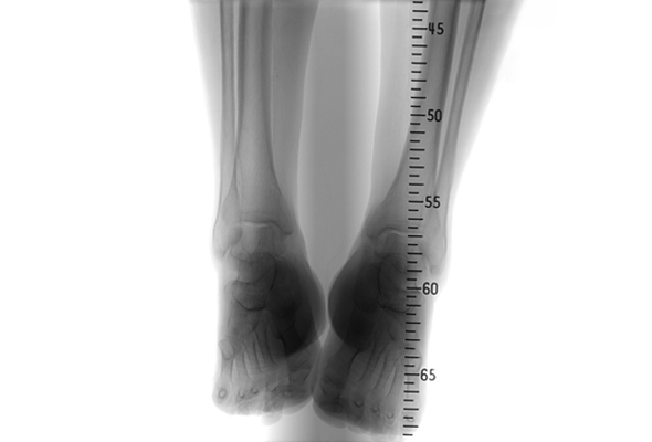 DSA-3D Becken-Beinarterien