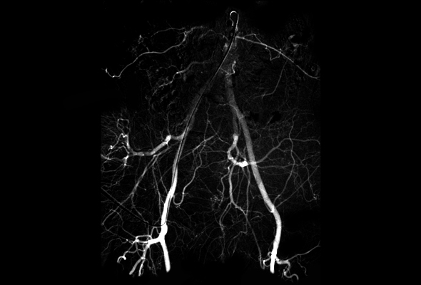 DSA Becken-Beinarterien